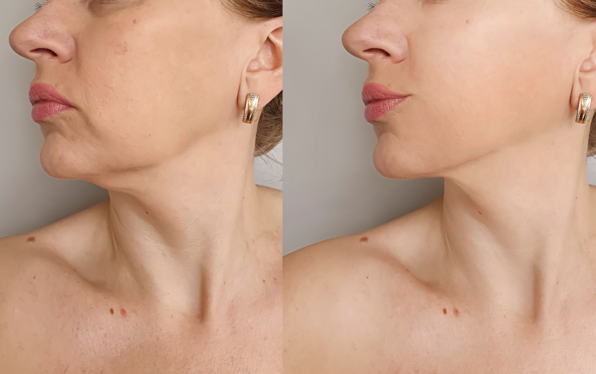 Side-by-side profile photos of a woman’s neck and jawline, showing a before-and-after comparison.