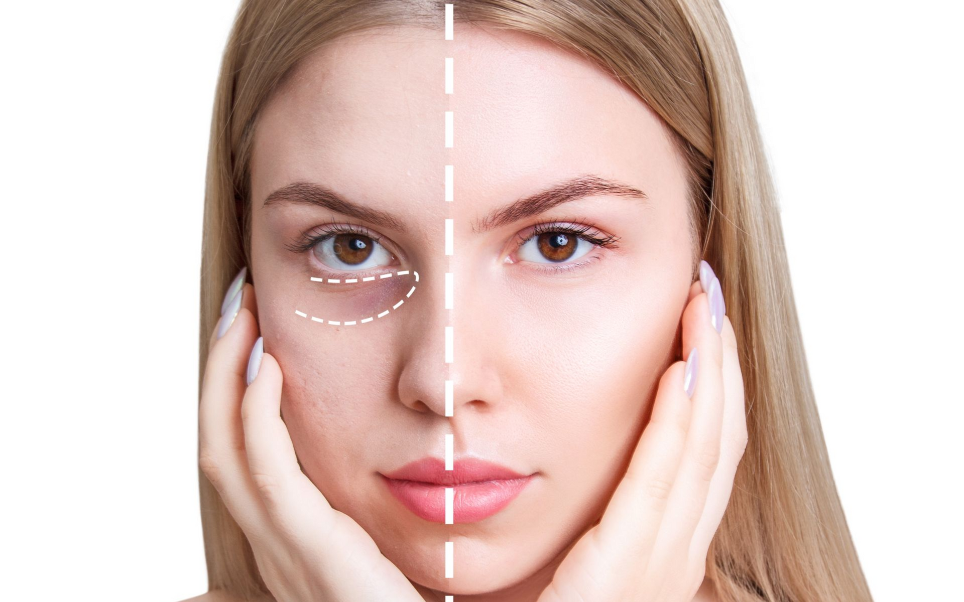 Close-up face split by a vertical line, showing before-and-after skin comparison with one clear and one blemished side