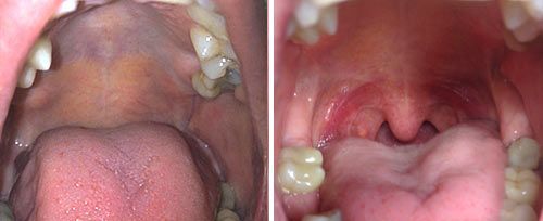 A close up of a person 's mouth with teeth and a sore throat.