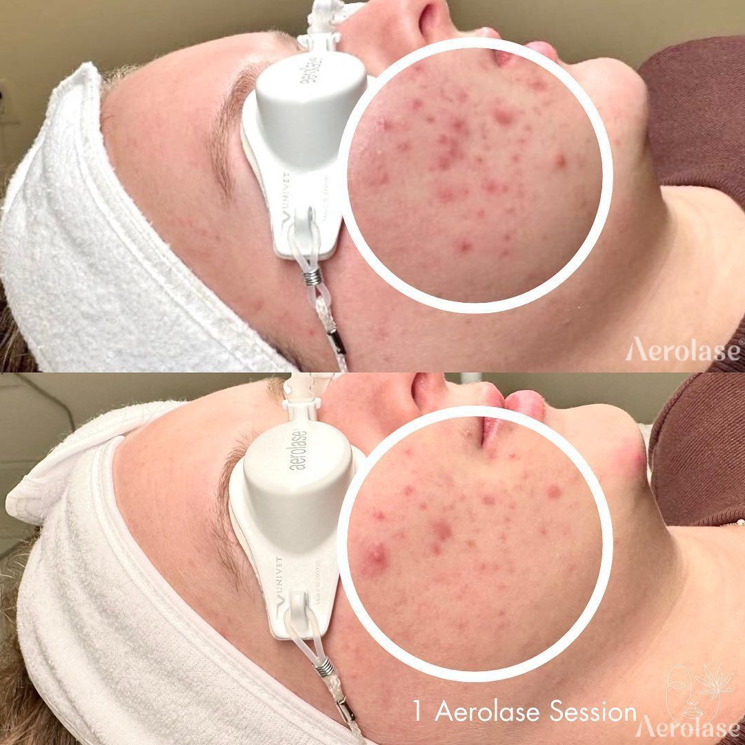 Before and after of a person's face. The top shows acne; the bottom shows reduced acne after one session.