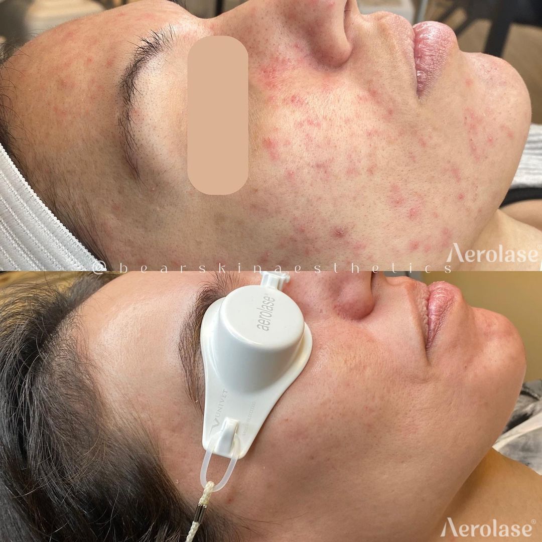 Before-and-after of a person's face. The top shows acne; the bottom shows improved skin after Aerolase treatment.