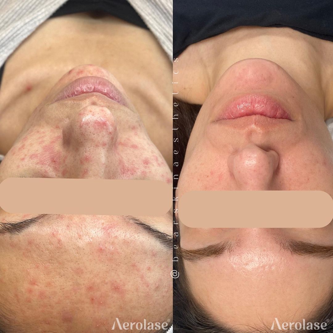 Comparison of skin before and after laser treatment, showing improved clarity and reduced redness.