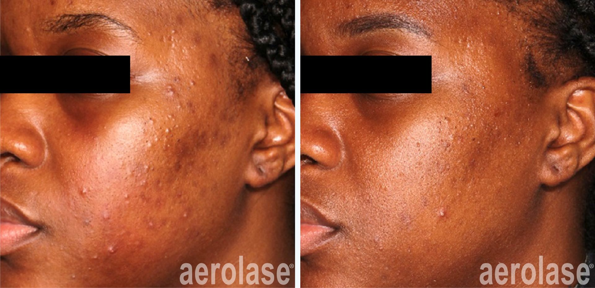 Side-by-side view of a person's face before and after skin treatment to reduce acne and discoloration.