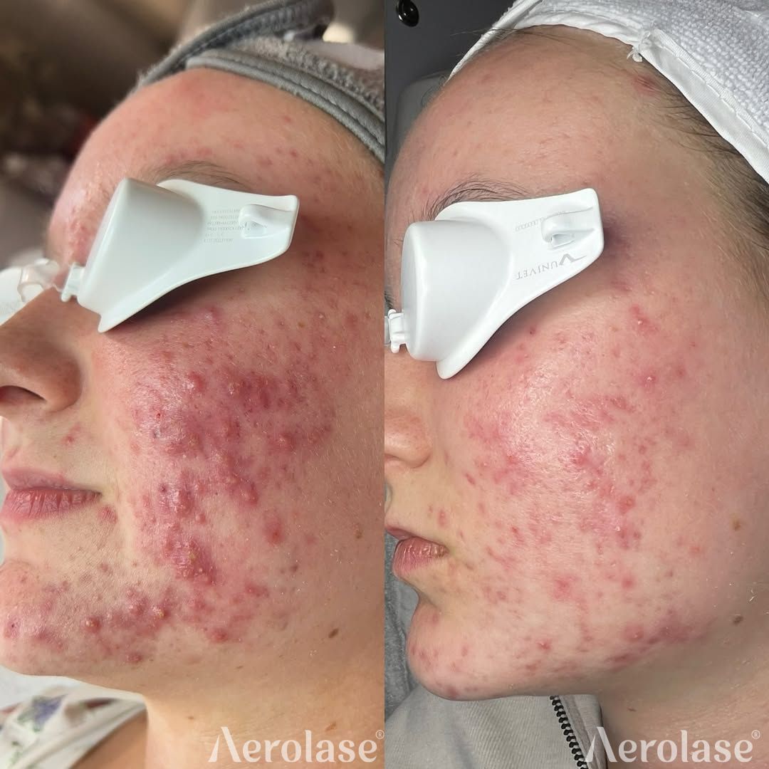 Aerolase acne treatment before and after. Red, inflamed skin improves significantly. Eyes protected by shields.