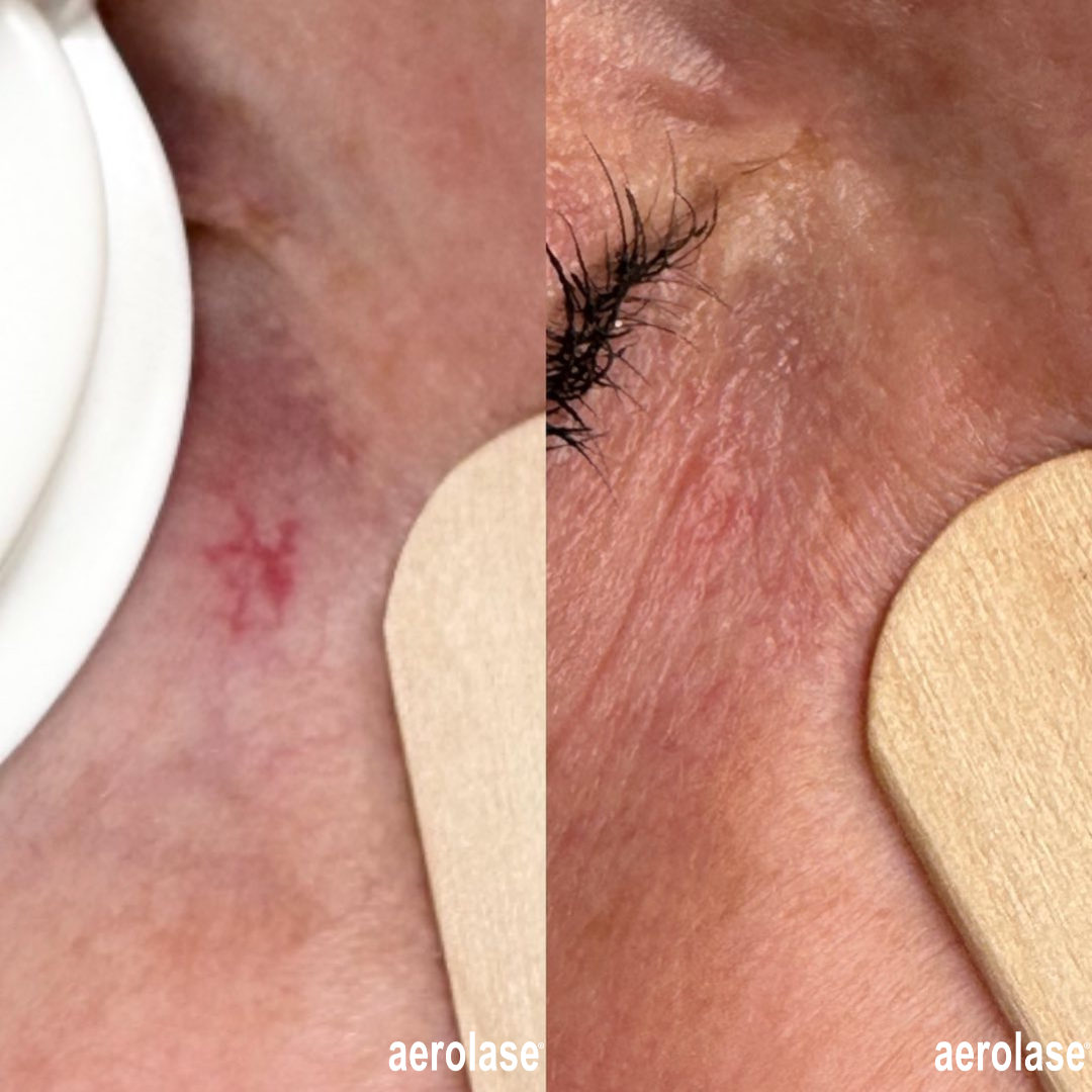 Aerolase laser treatment before and after: Red blood vessels on skin visibly reduced.