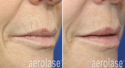 Before-and-after of a person's upper lip area. Fine lines reduced; lips appear fuller after laser treatment.