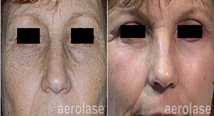 Comparison of a face before and after skin treatment, showing reduced wrinkles and improved skin tone.