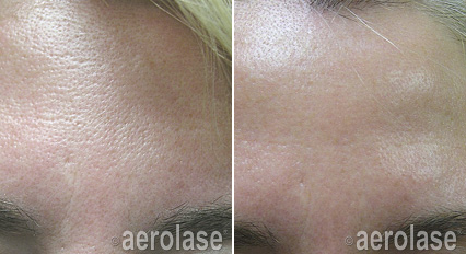 Forehead before and after laser treatment; skin texture improved.