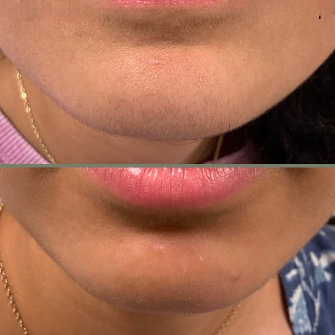 Side-by-side comparison of a person's chin before and after hair removal; chin appears smoother after.