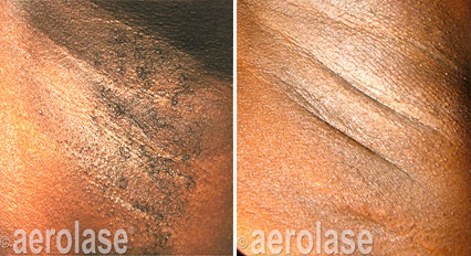 Aerolase laser treatment on underarm; before and after showing reduction in darkness.