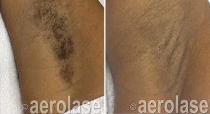 Before and after of armpit hair removal, showing hair before and smooth skin after laser treatment.