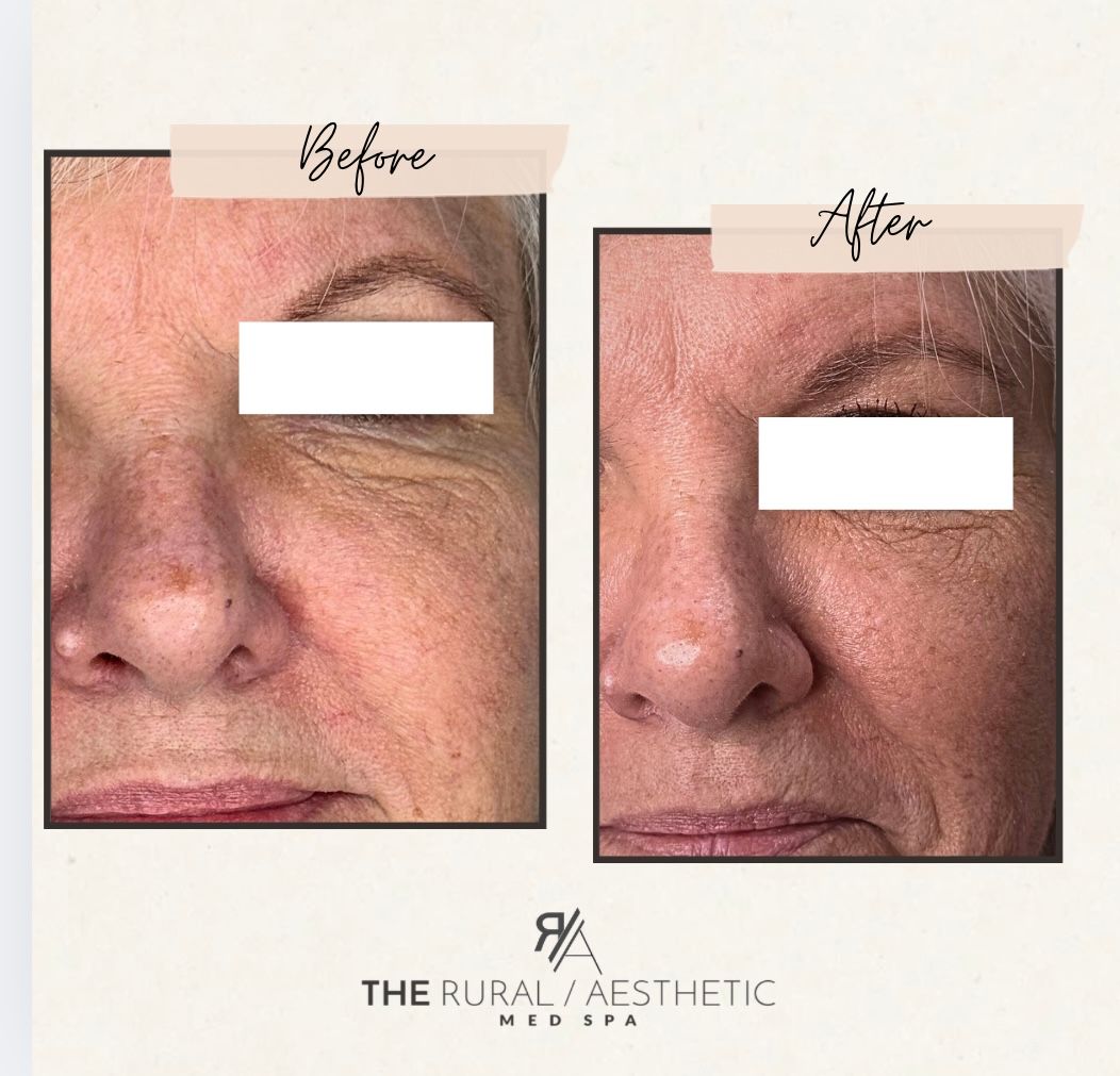 Two side-by-side close-up face photos showing skin before and after treatment, with branding at bottom