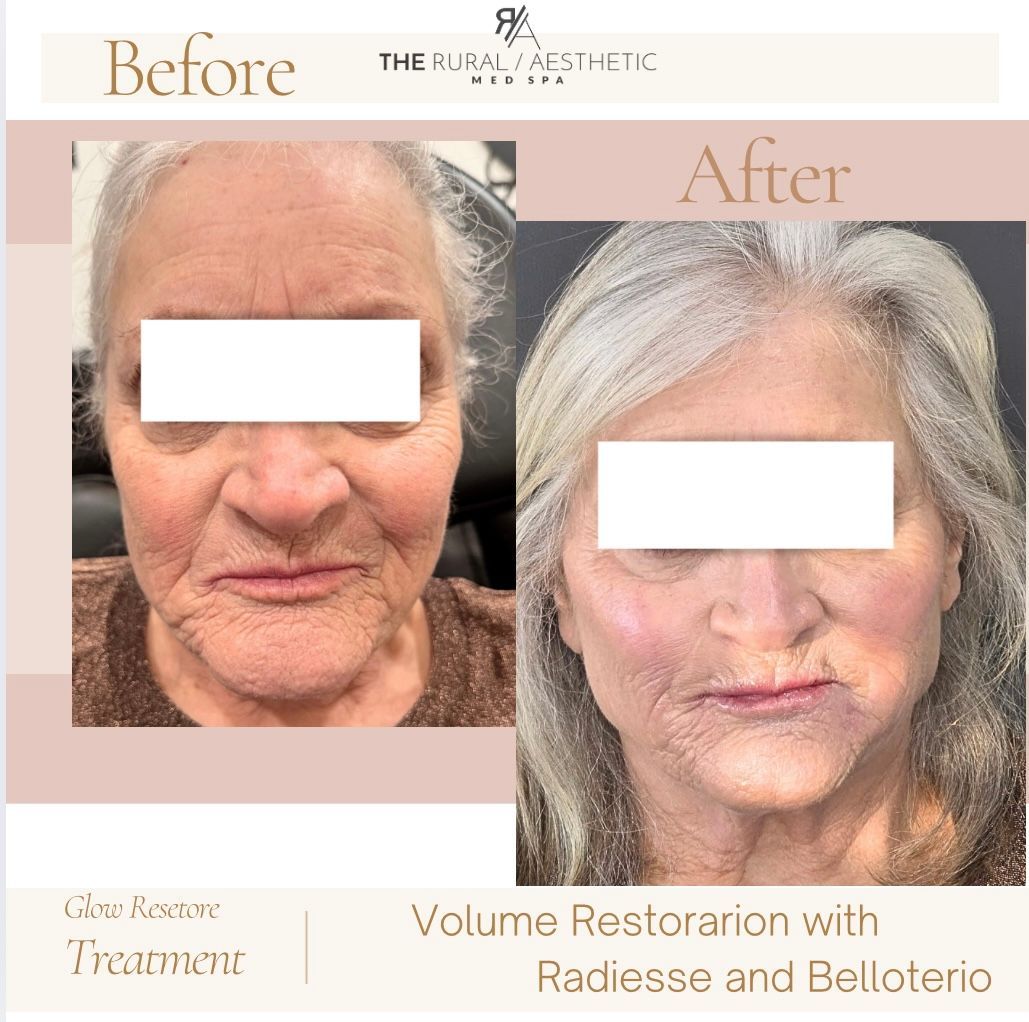Before-and-after facial treatment comparison showing smoother skin and a fuller face.