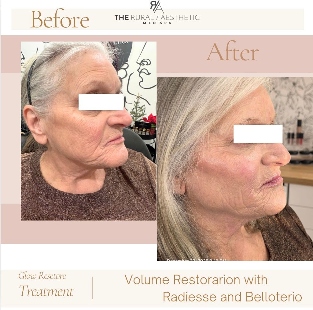 Before-and-after side profiles of a woman’s face showing volume restoration treatment results.