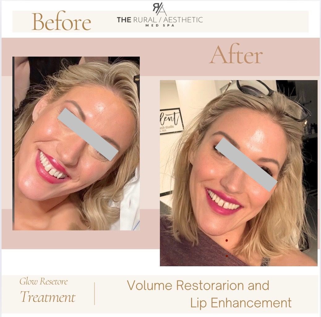 Before-and-after cosmetic treatment collage of a smiling woman, showing volume restoration and lip enhancement.