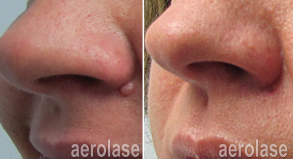 Nose before and after laser treatment to remove a growth. Right side shows the treated nose.