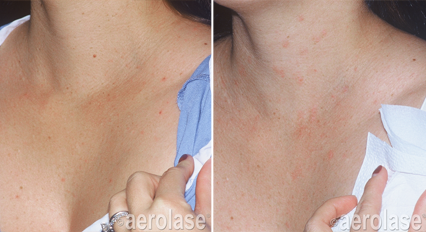 Side-by-side comparison of a person's chest and neck, before and after a treatment, showing a reduction of skin redness.