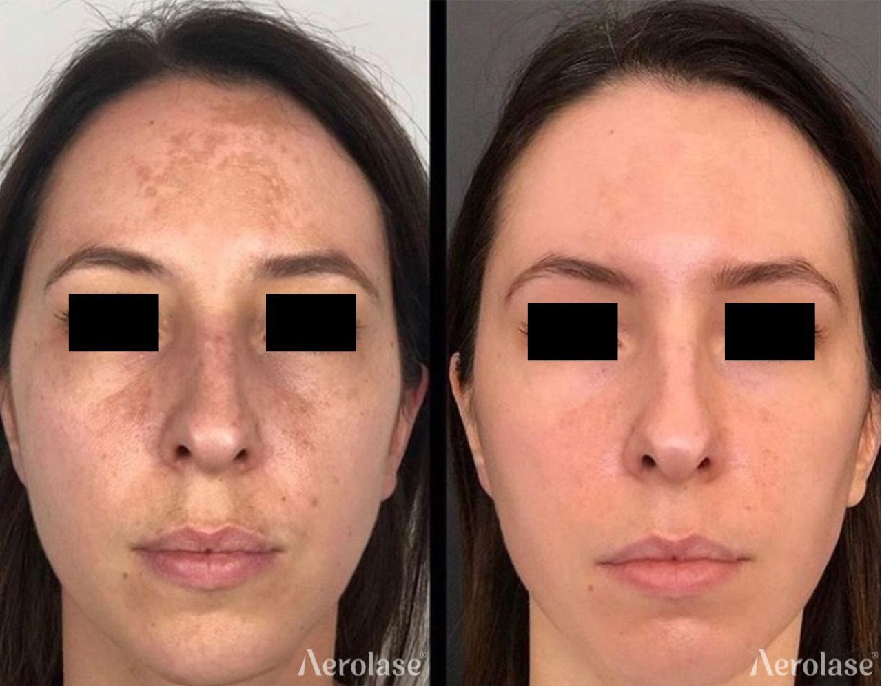 Before-and-after facial skin comparison: dark spots reduced after laser treatment.