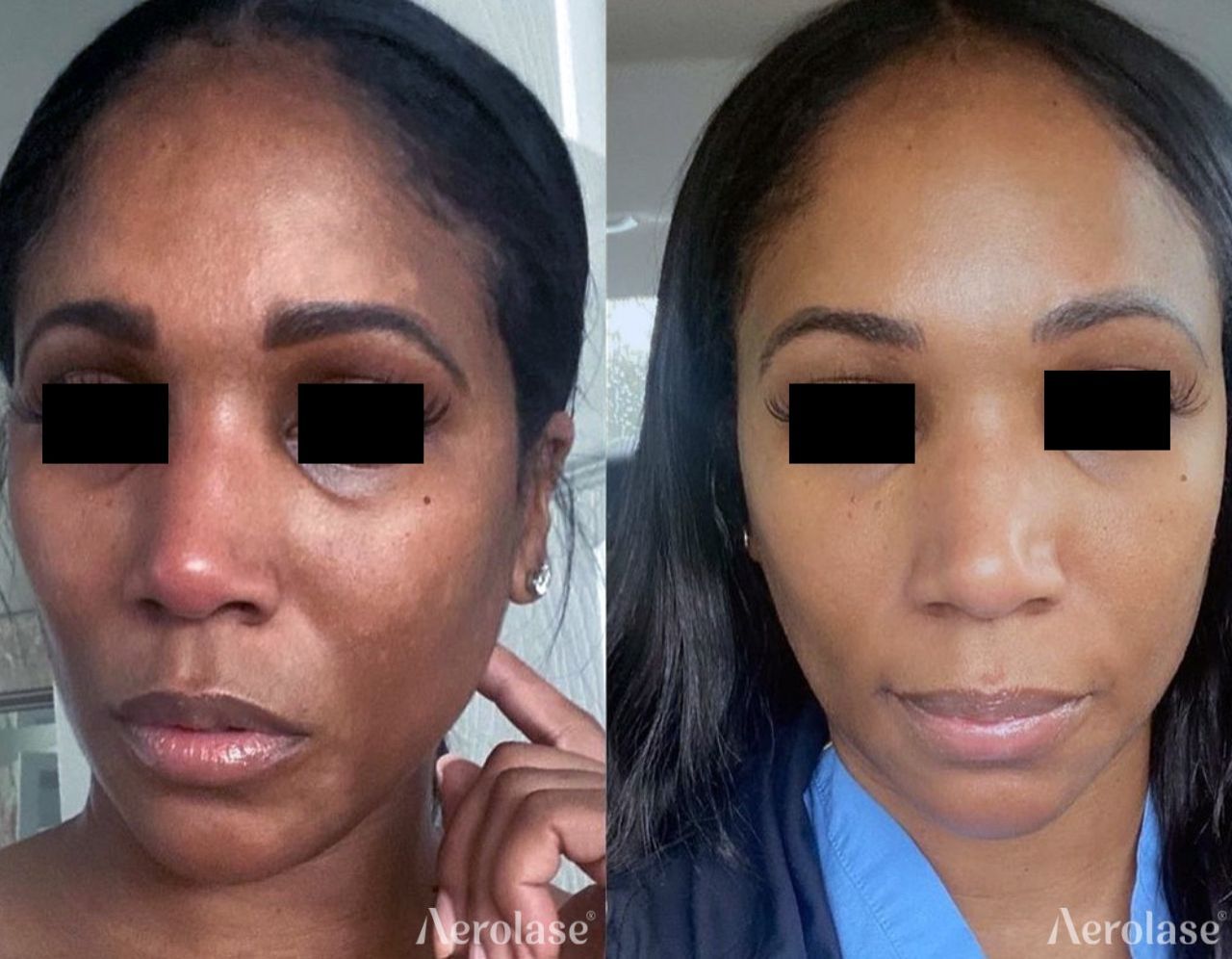 Before and after comparison of a person's face; skin tone appears more even, with reduced discoloration.