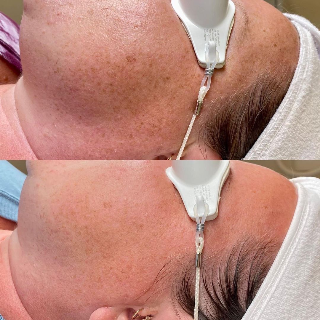 Before and after photos of skin treatment on a person’s face and neck; showing reduction in brown spots.