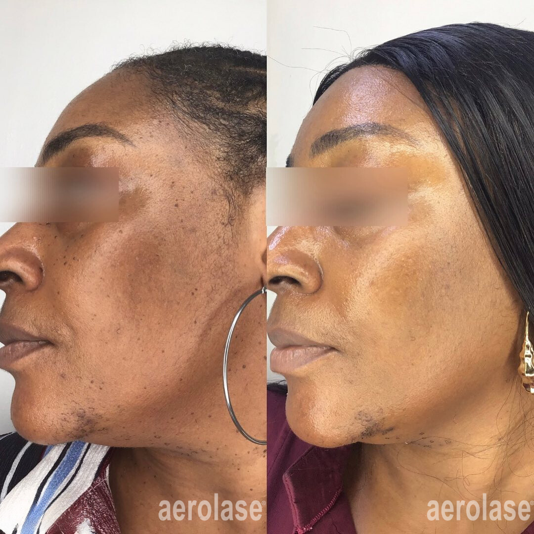 Side-by-side comparison of a person's face before and after a skin treatment. Changes include reduced hair.