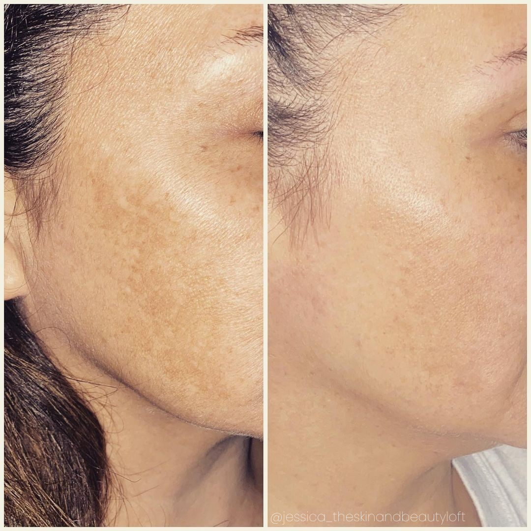 Side-by-side photos of a person's face. Left shows more visible skin imperfections, right shows improved skin texture.