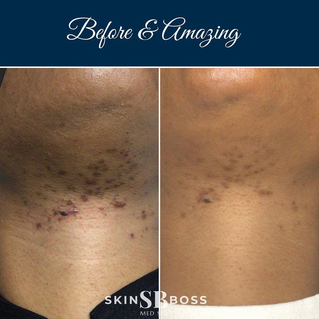 Side-by-side comparison of a neck, showing skin discoloration before and improved after treatment.