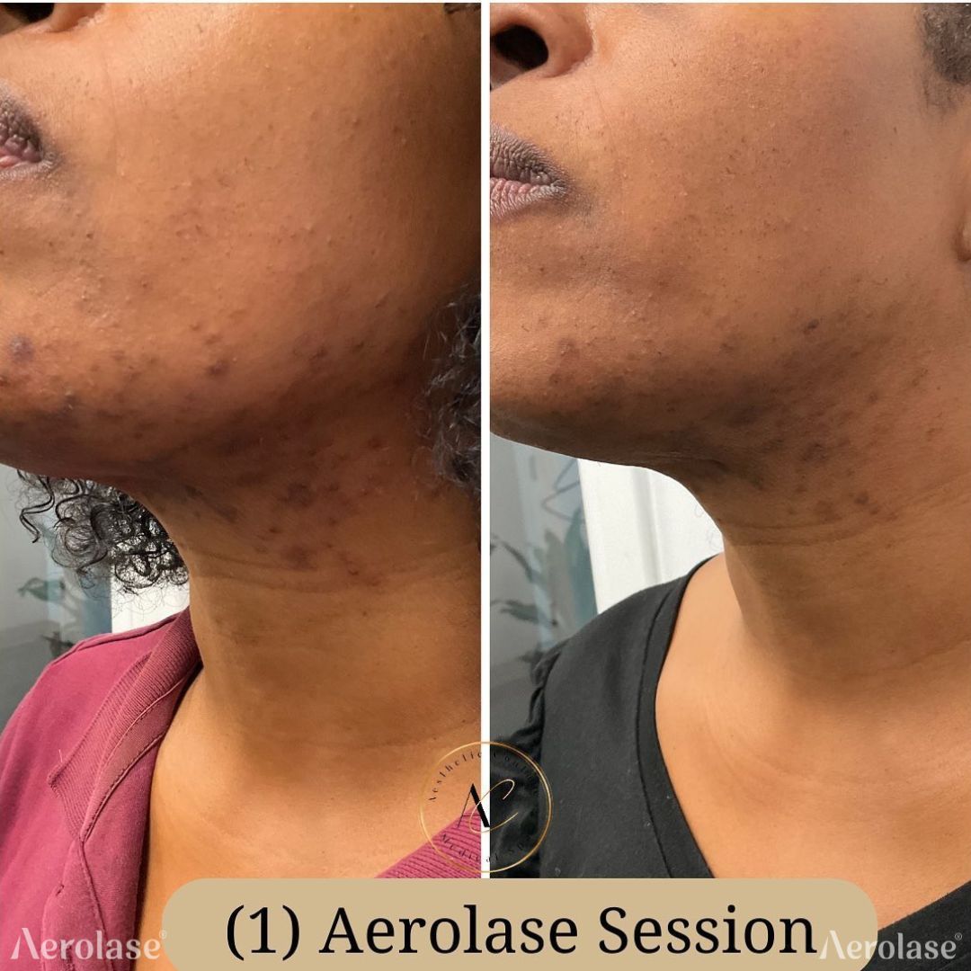 Side-by-side comparison shows a person's neck/jawline before/after Aerolase treatment. Skin appears smoother, with reduced hair.