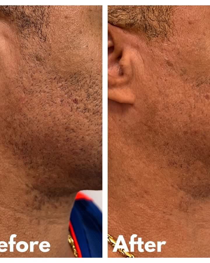 Side-by-side comparison of a person's jawline, before and after a treatment, showing a smoother appearance.