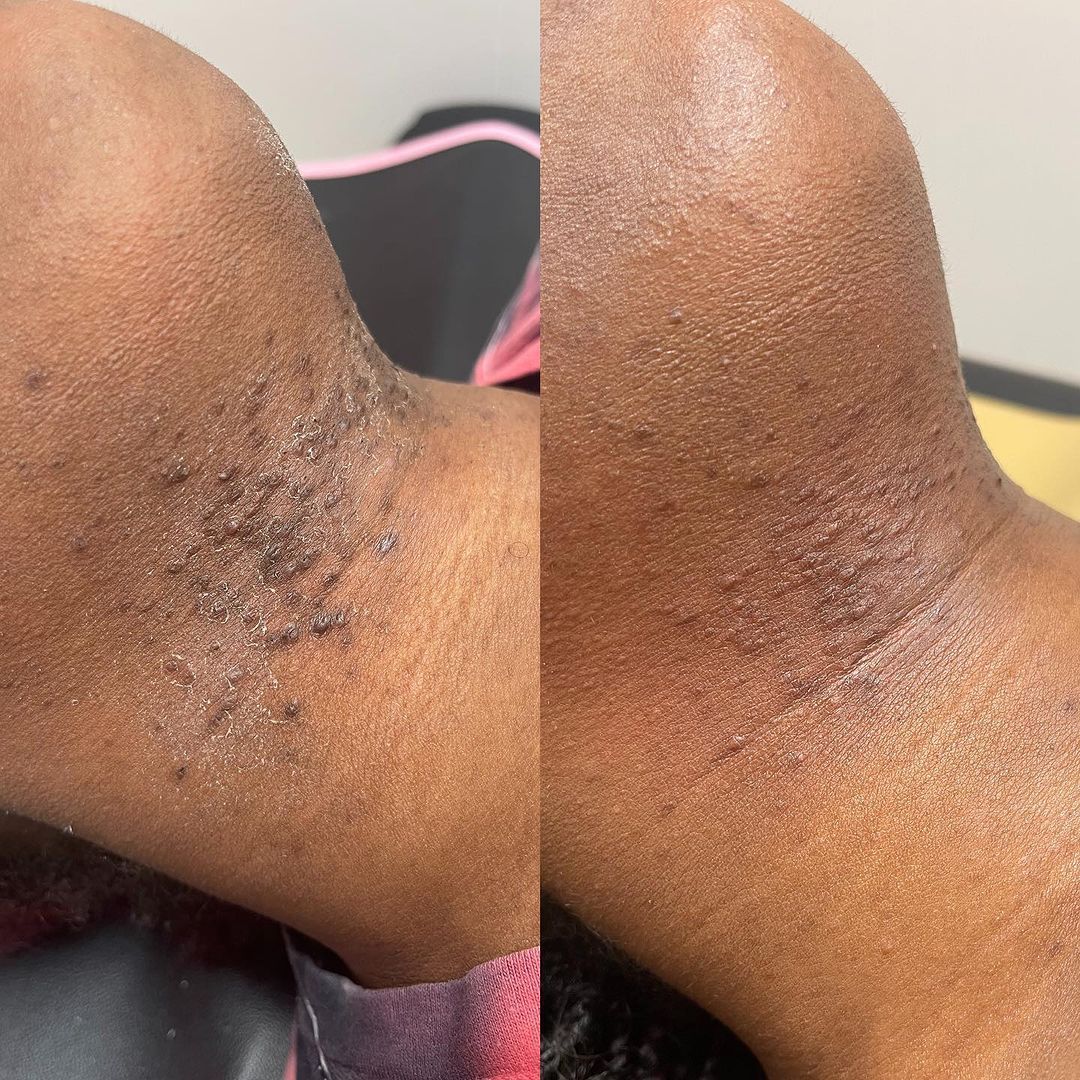 Comparison of armpit skin before and after a procedure, showing dark discoloration fading.
