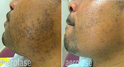 Side-by-side comparison of a person's face before and after skin treatment, with reduced dark spots.