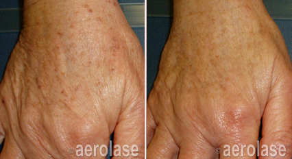 Before and after of hand showing reduction in age spots after laser treatment.