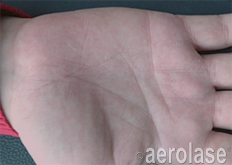Palm of a hand, showing skin texture and lines.