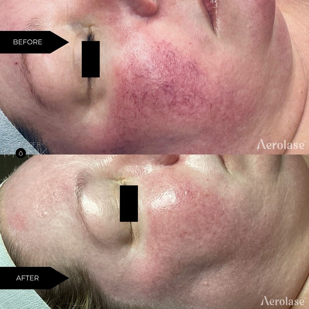 Comparison of a person's face before and after laser treatment to reduce facial redness.