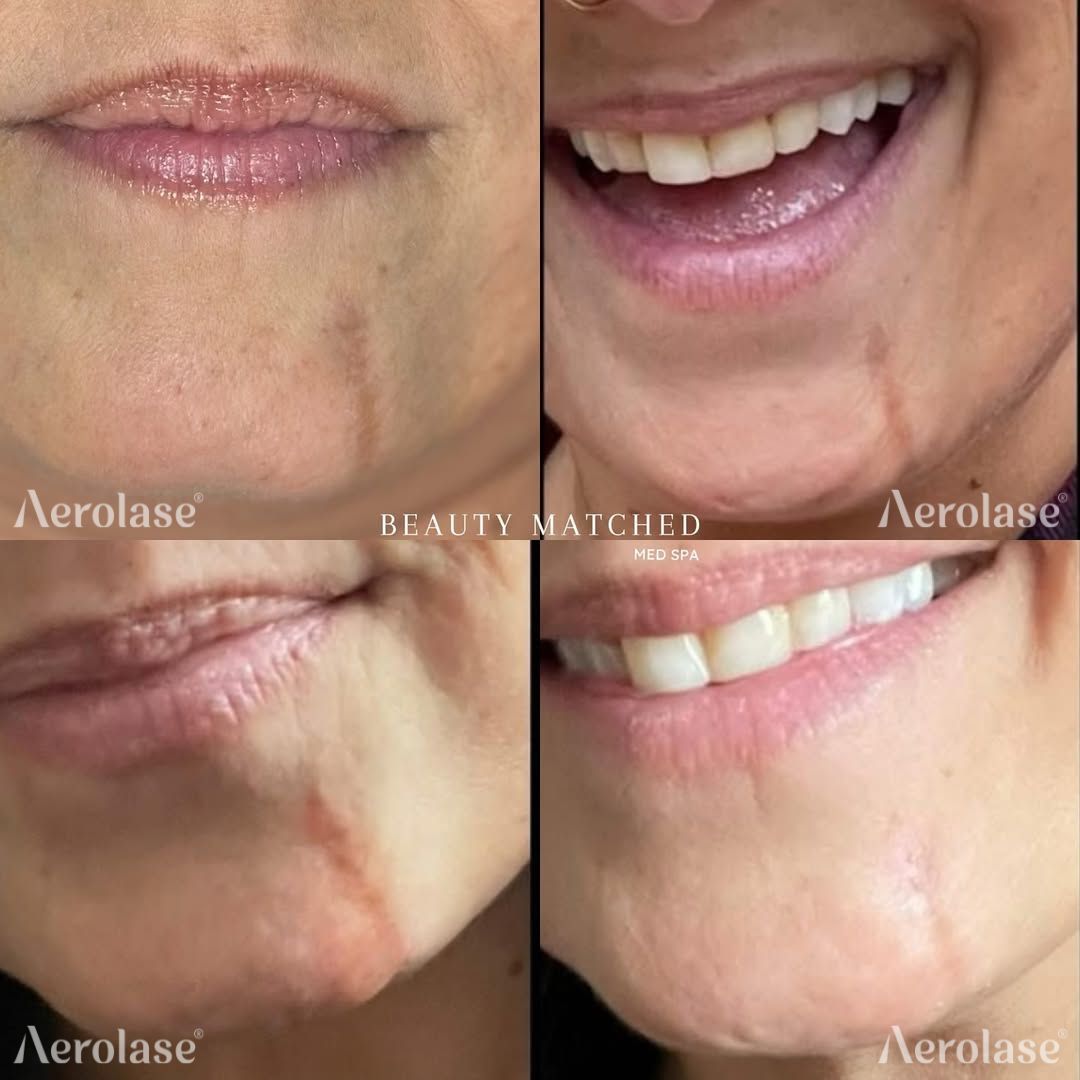 Four-panel comparison of lips/chin before and after Aerolase laser treatment, showing scar reduction.