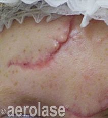 Close-up of skin with a red, raised scar. Aerolase watermark is visible.