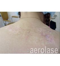 Back of a person with light-colored skin, displaying areas of discoloration, potentially indicating a skin condition or treatment.
