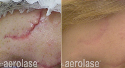 Before-and-after of a face with a scar, showing a reduction in the scar's appearance after treatment.