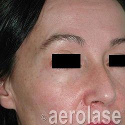 Close-up of a person's face with skin discoloration and the