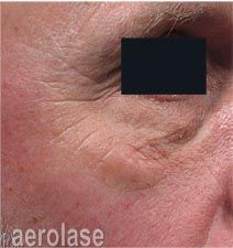Close-up of a person's eye area with wrinkles. The eye is partially covered by black. Skin is reddish.
