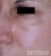 Close-up of a person's face showing skin with visible pores and discoloration, likely for dermatological analysis.