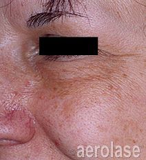 Close-up of a person's face showing skin discoloration with visible lines, and the brand 