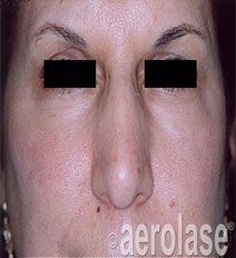 Close-up of a person's face showing uneven skin tone, visible pores, and slight redness, with the eyes blocked.