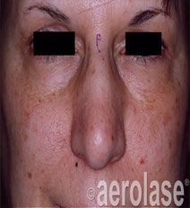 Close-up of a person's face showing skin discoloration, including around the eyes and on the cheeks.
