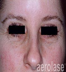 Close-up of a person's face showing wrinkles and discoloration around the eyes and cheeks.