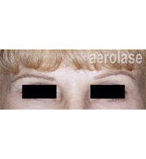 Close-up of a person's eyes, with eyebrows visible. Eyes are covered with black rectangles.