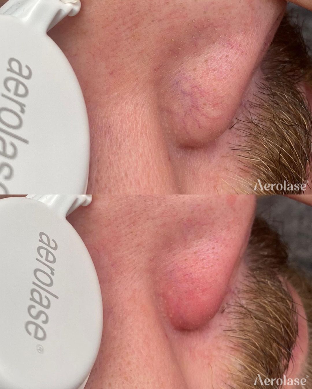 Before and after photos showing an Aerolase laser treatment on a person's nose.