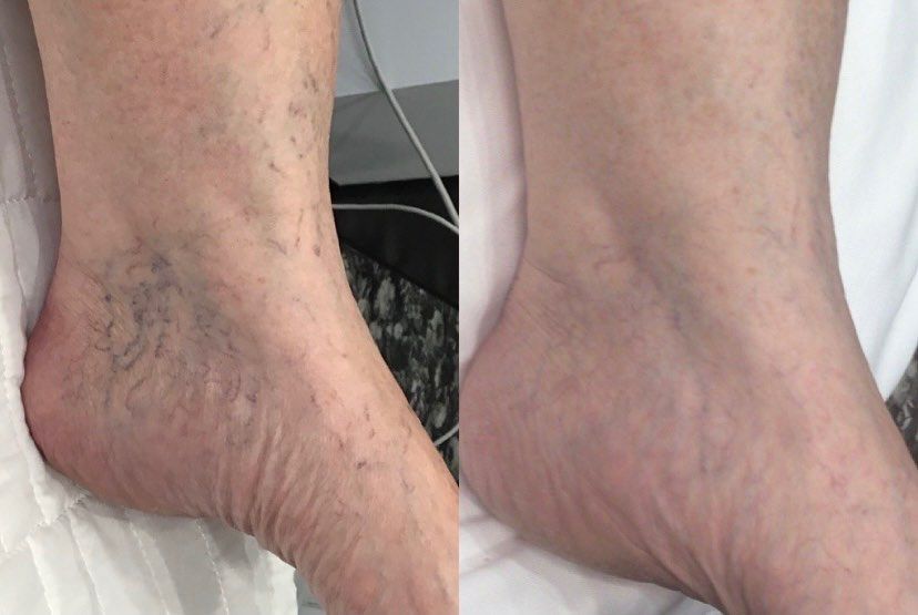 Comparison of a foot with visible veins (left) and foot after treatment (right), showing reduced vein visibility.