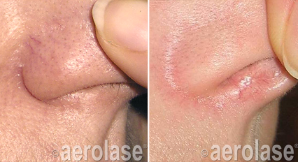 Before and after views of skin lesions, likely treated with a laser, on a person's face near the nose.