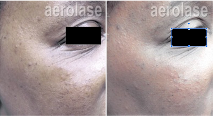 Side-by-side view of a person's face. Left side shows before treatment with uneven skin tone. Right side shows improved skin tone after treatment.